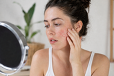 5 Signs Your Skin Barrier Needs Niacinamide (Not More Actives)